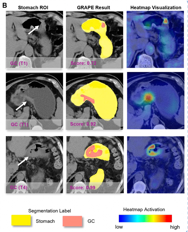 为了消灭癌症 他们把几千份遗憾喂给代码