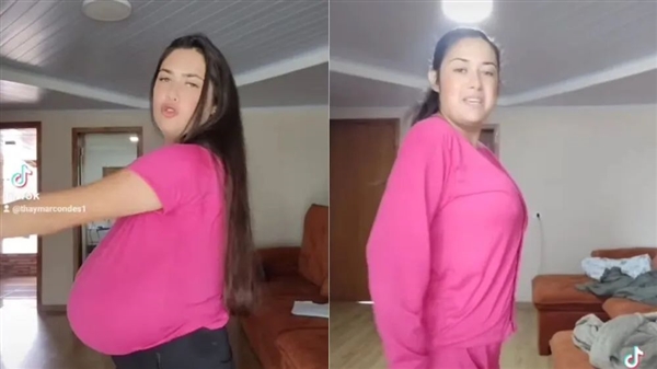 巴西女子患“巨乳症”失控!短短几月长O杯 出行得坐轮椅