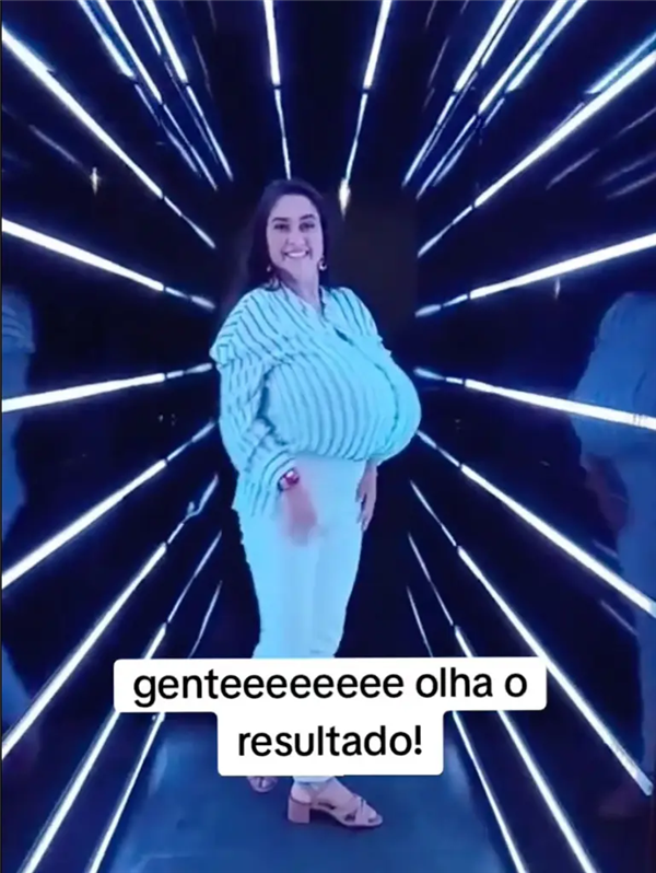 巴西女子患“巨乳症”失控!短短几月长O杯 出行得坐轮椅