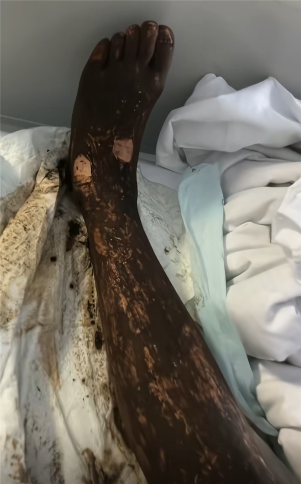 男子同时被五步蛇和竹叶青咬伤 腿严重肿胀 网友：这概率买彩票吧