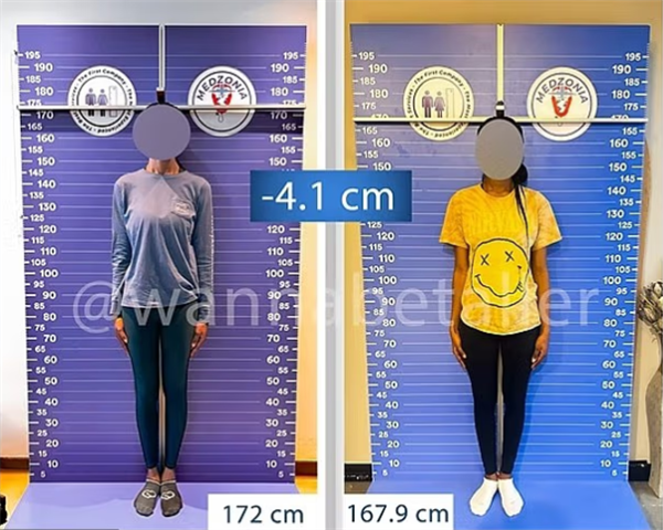 太疯狂!嫌个子太高不好找对象 女子手术切骨变矮