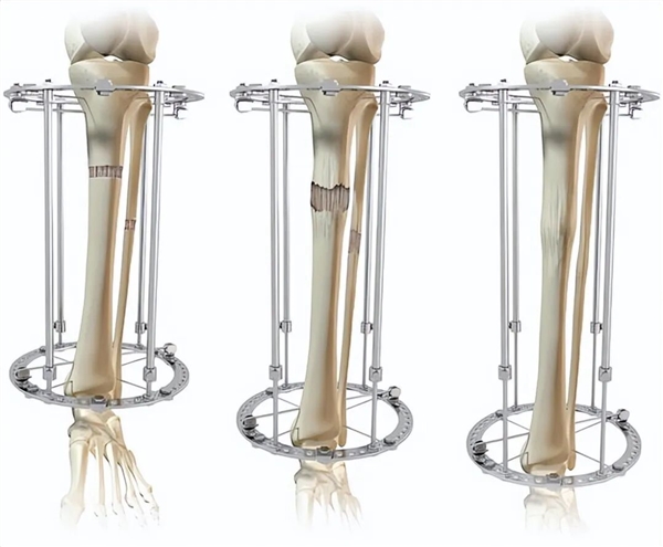 太疯狂!嫌个子太高不好找对象 女子手术切骨变矮