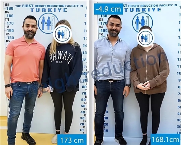 太疯狂!嫌个子太高不好找对象 女子手术切骨变矮