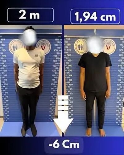 太疯狂!嫌个子太高不好找对象 女子手术切骨变矮