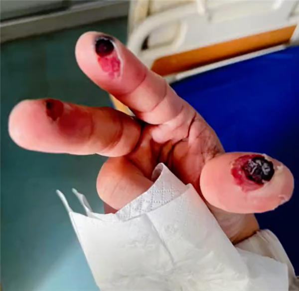 别名“化骨水”!女子散步时踩到氢氟酸后不幸去世