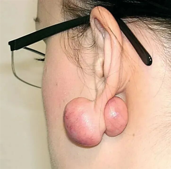 为什么没有人告诉我 打耳洞后会长这种肉疙瘩啊