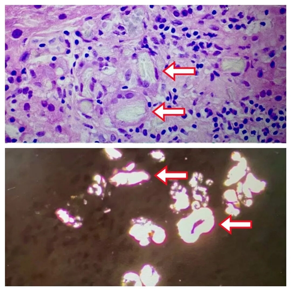 这种常见蔬菜吃多了 居然会引发严重急性肾损伤!