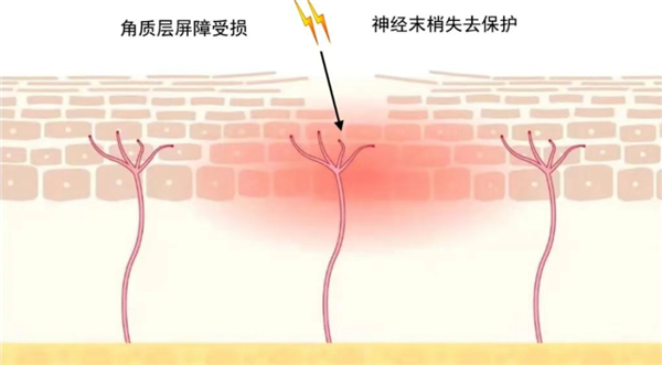 没伤口却疼得像针扎 揭秘皮肤突发刺痛的常见诱因