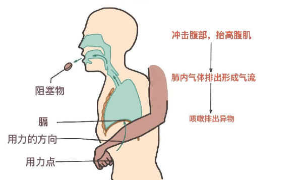 海姆立克急救法更新了:先拍5次背 再做“剪刀石头布”