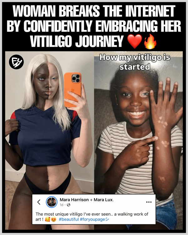 一个患有白癜风的美国女孩火了 网友：还真能这么均匀