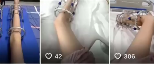 央视曝光断骨增高灰色产业链:女子出国做手术腿部严重感染喷脓