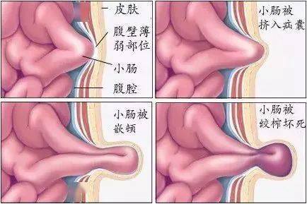 关爱老年疝气患者：春节期间的隐形风险