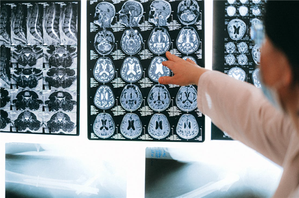 精准定位抑郁症！西湖大学算法创新绘制大脑疾病细胞导航图